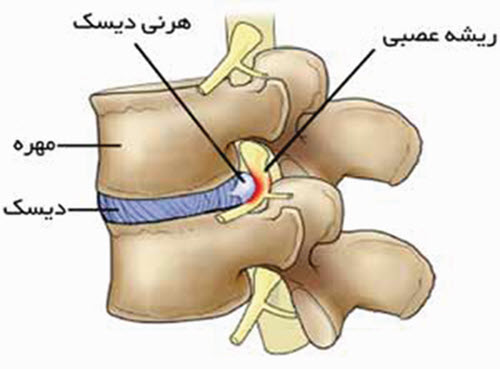 جراحی گردن